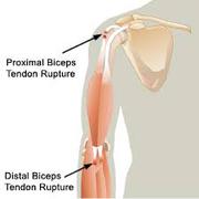 Shoulder Replacement Surgery Irving