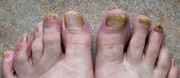 Antifungal Foot Care Serum N-- Scientific- https://tinyurl.com/fhtdc8w